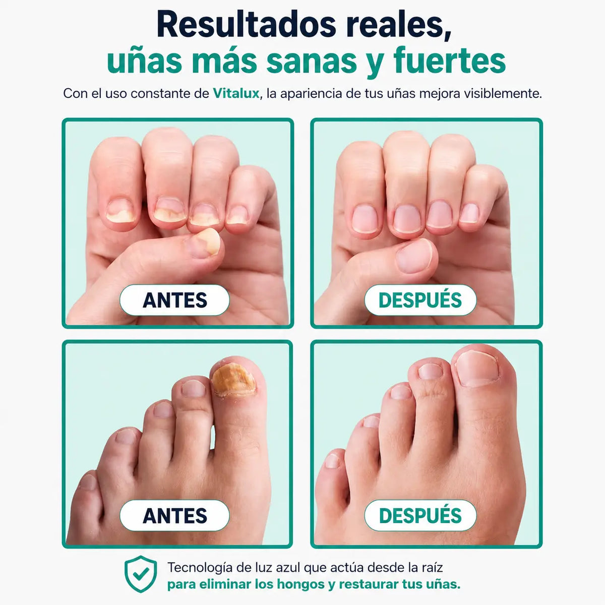 Laser Antihongos para Uñas