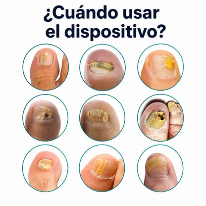 Laser Antihongos para Uñas